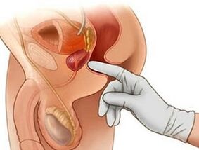 Масаж на простатата за лечение на простатит при мъжете