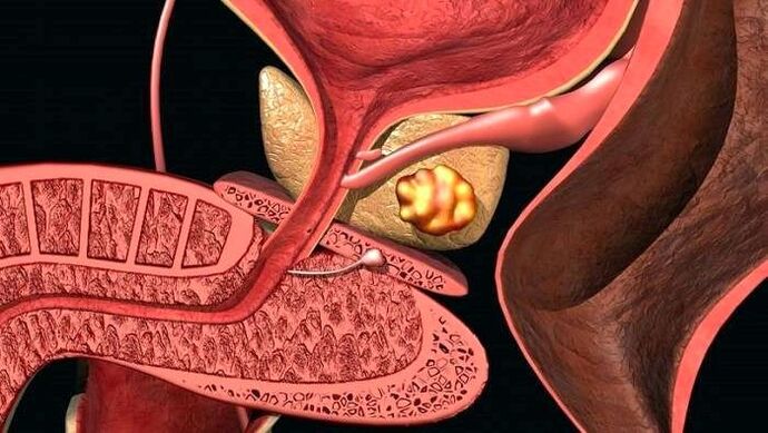 Отлагания на камъни в простатата с калкулозен простатит