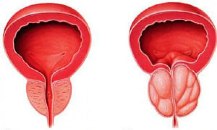 Нормална простата (вляво) и възпален хроничен простатит (вдясно)